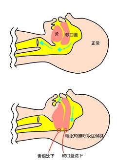 戸田市のパーソナルジムHealthyのいびきに関するブログ いびきの原因のイラスト